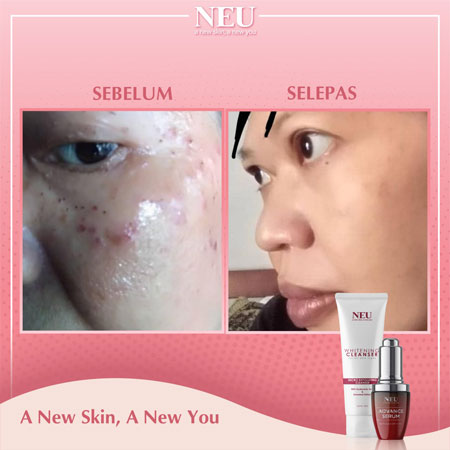 testimoni-neu-serum-7