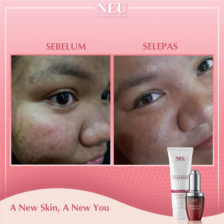 testimoni-neu-serum-9